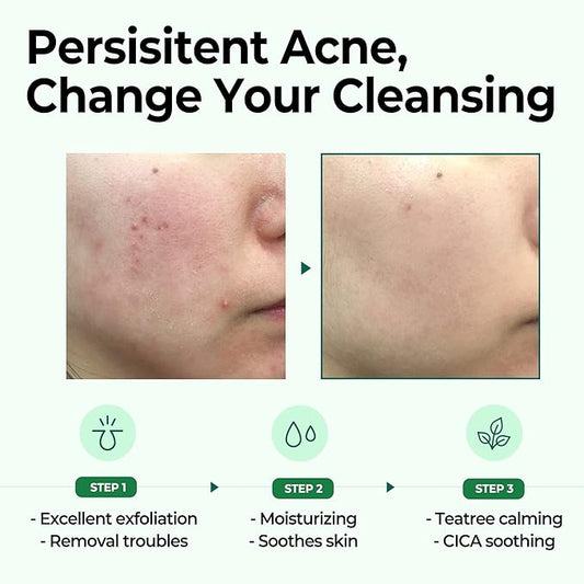 Some By Mi – AHA, BHA, PHA 30 Days Miracle Cleansing bar 95g