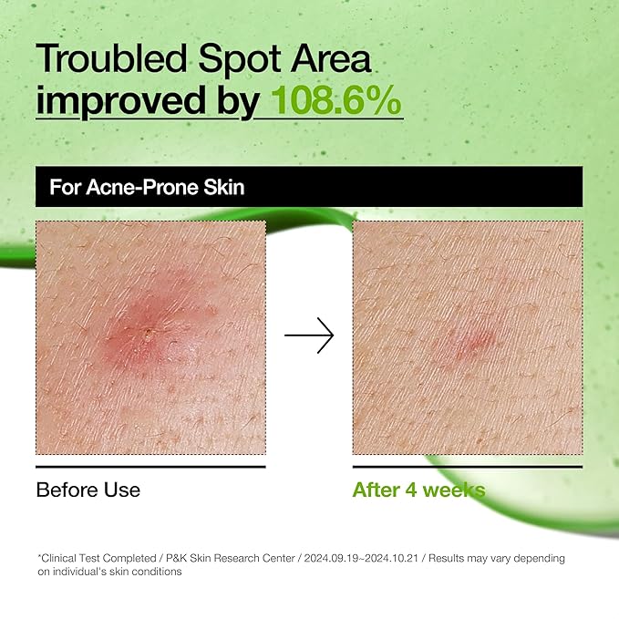 Anua – Azelaic Acid 10 Hyaluron Redness Soothing Serum