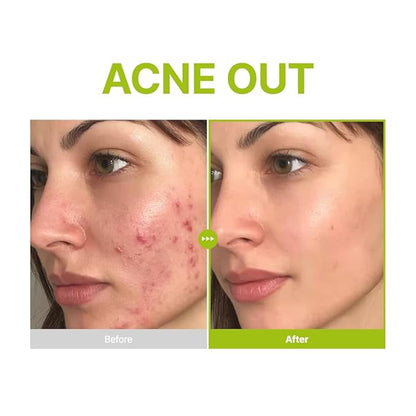 Purito – Azelaic Acid 10 Kojic Tea Tree Serum 30ml